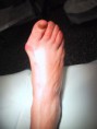 /album/galeria-de-fotos/healthbase-medical-tourism-bunion-removal-surgery-bunionectomy-hallux-valgus-jpg/